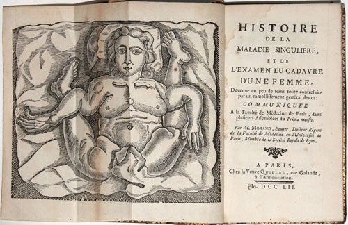 Item #5467 Histoire de la maladie singuliere, et du l’examen du cadaver d’une femme, devenue en peu de tems toute contrafaie par un ramollissement général des os. Jean-François-Clément MORAND.